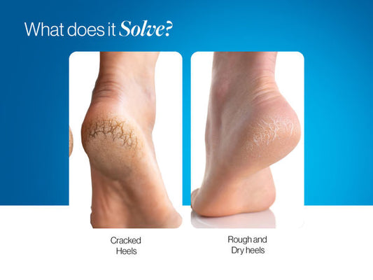 20% Urea Foot Roll On - 50 ml