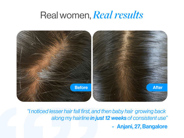 Advanced Hair Growth Serum Roll On - 3% Redensyl, 3% Rosemary (25 ml)