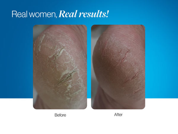 20% Urea Foot Roll On - 50 ml