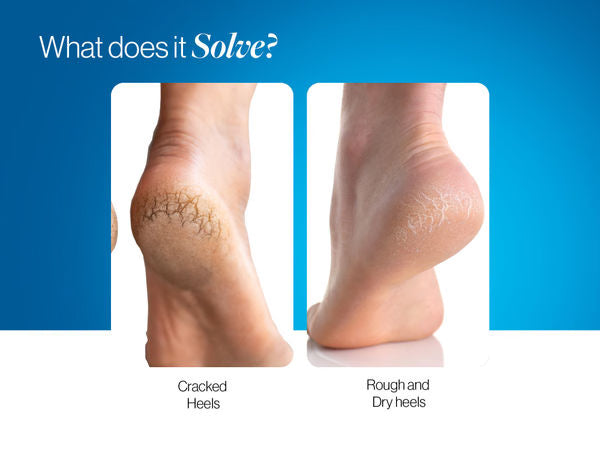 20% Urea Foot Roll On | 75 ml