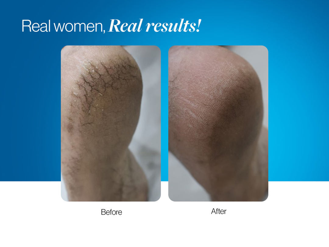 20% Urea Foot Roll On | 75 ml